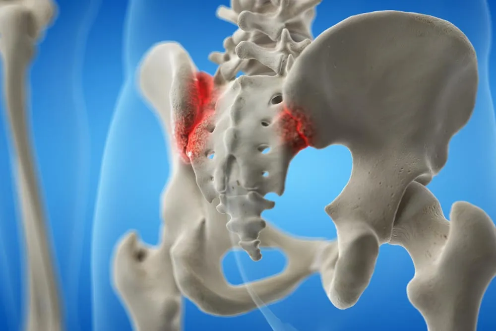 Viêm khớp cùng chậu có nguy hiểm không? Cách điều trị là gì?